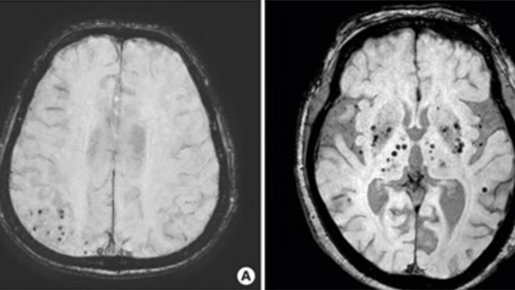 Characteristics Of Cerebral Microbleeds SpinTech MRI