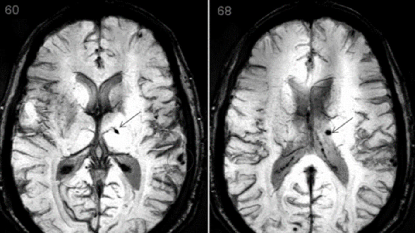 Microhemorrhages Minor TBI edit