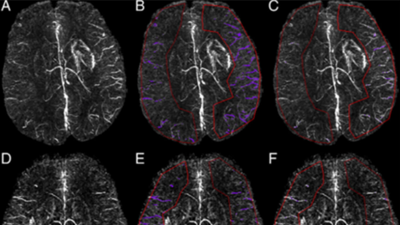 Cortical Vein Susceptibility edit