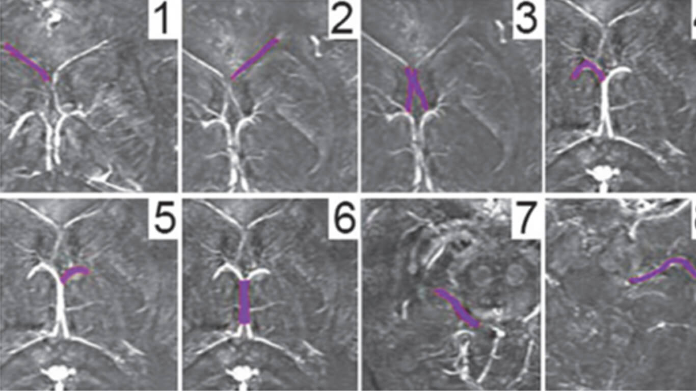 Vein Susceptiblity Analysis edit