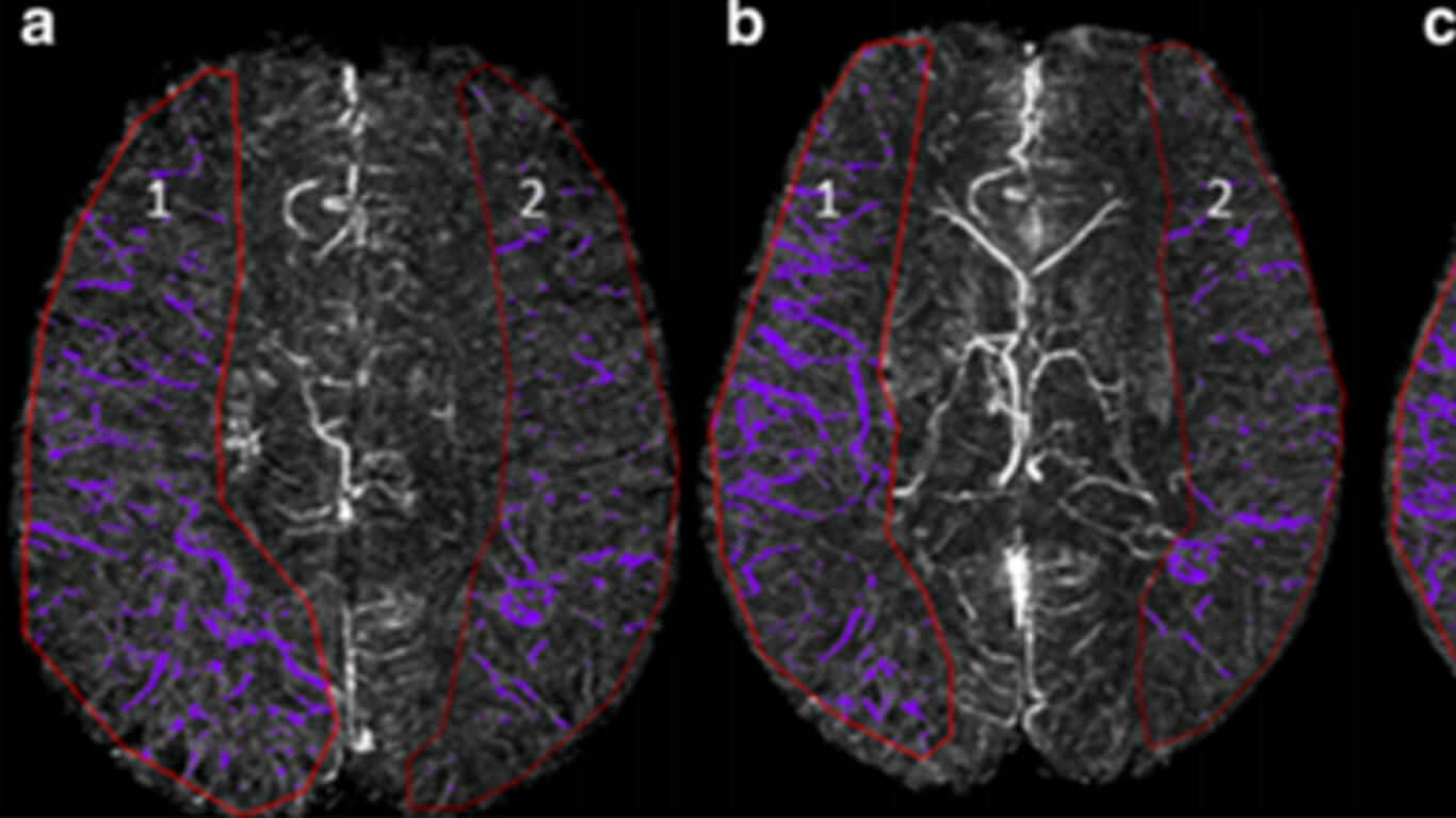 Bilateral Cortical Veins edit