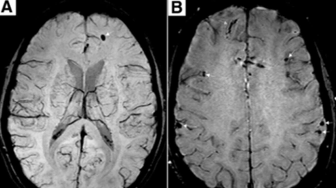 Microhemorrhages SWI resize