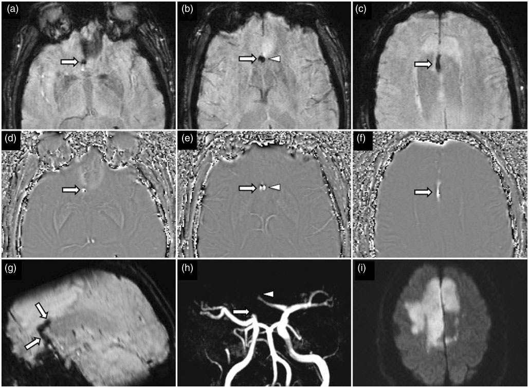 Susceptibility weighted imaging in acute cerebral ischemia
