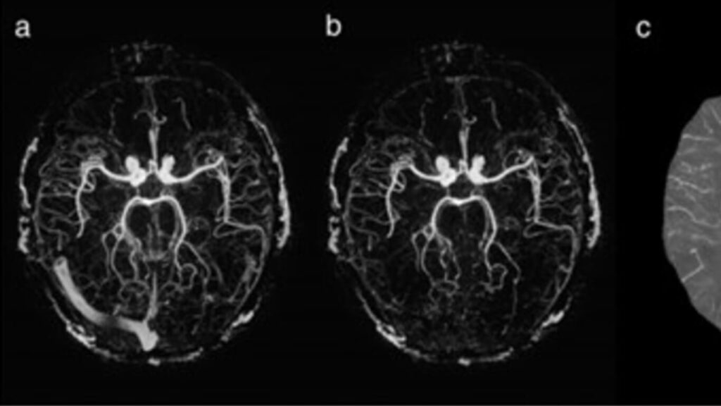 An Interleaved Sequence For Simultaneous Magnetic Resonance Angiography Mra Susceptibility 7300