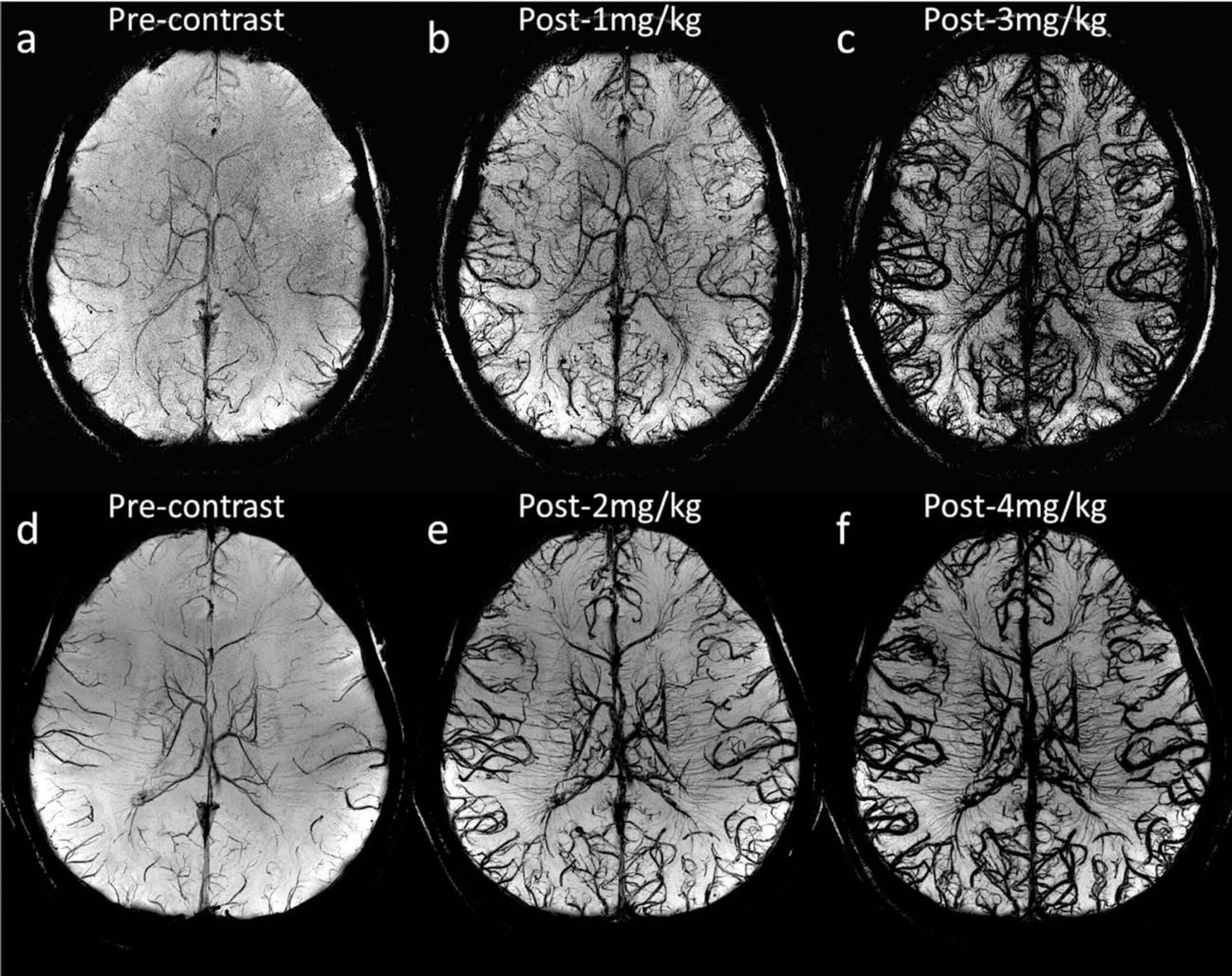 Susceptibility Weighted Imaging and Quantitative Susceptibility Mapping ...
