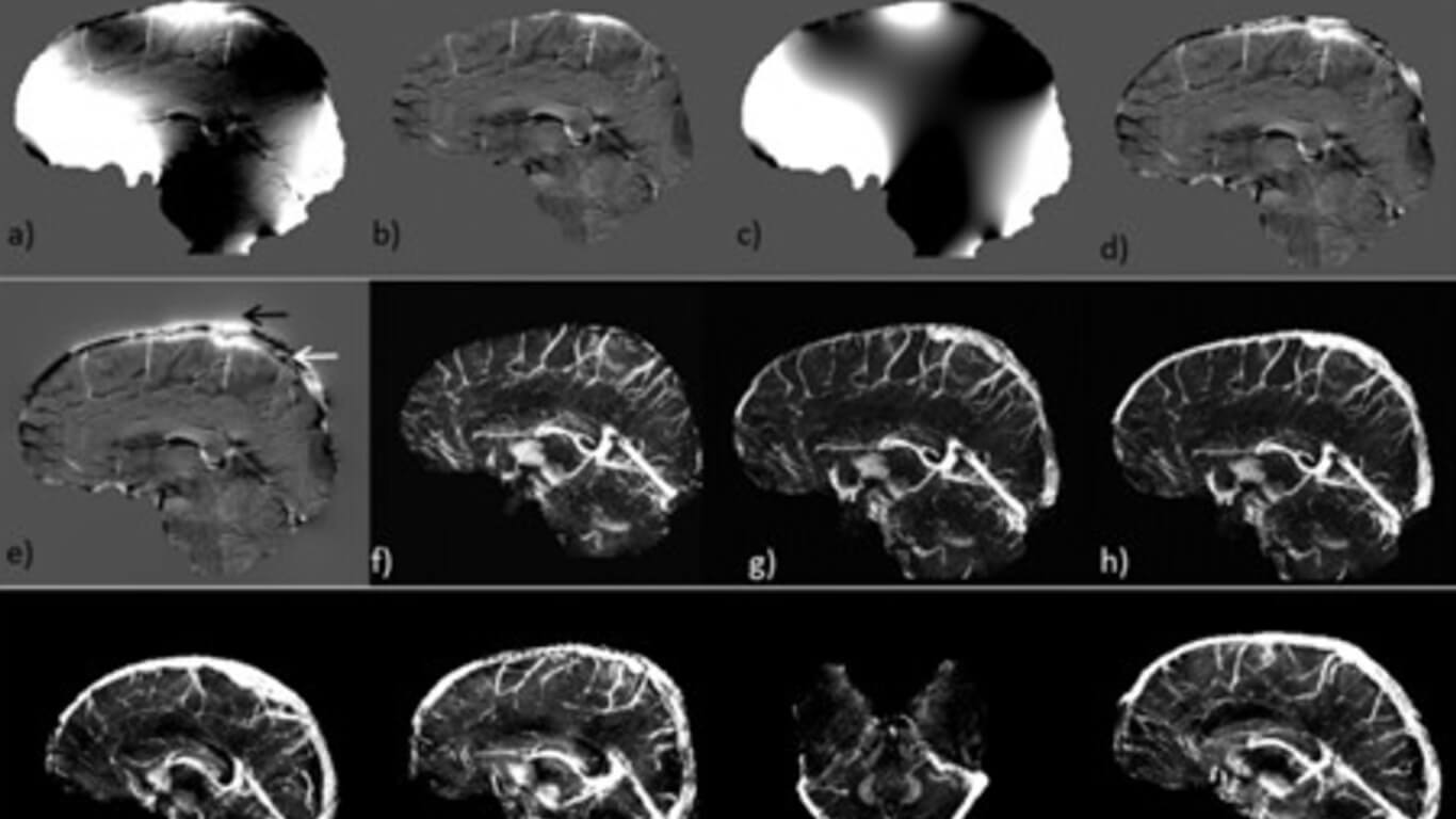 Dural Sinus Scan edit