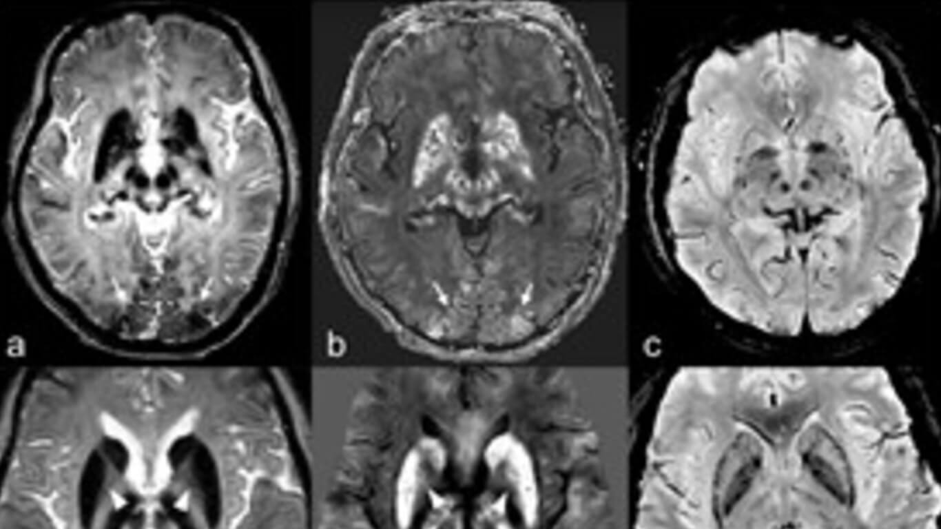 Intracranial Iron Aceruloplasminemia edit