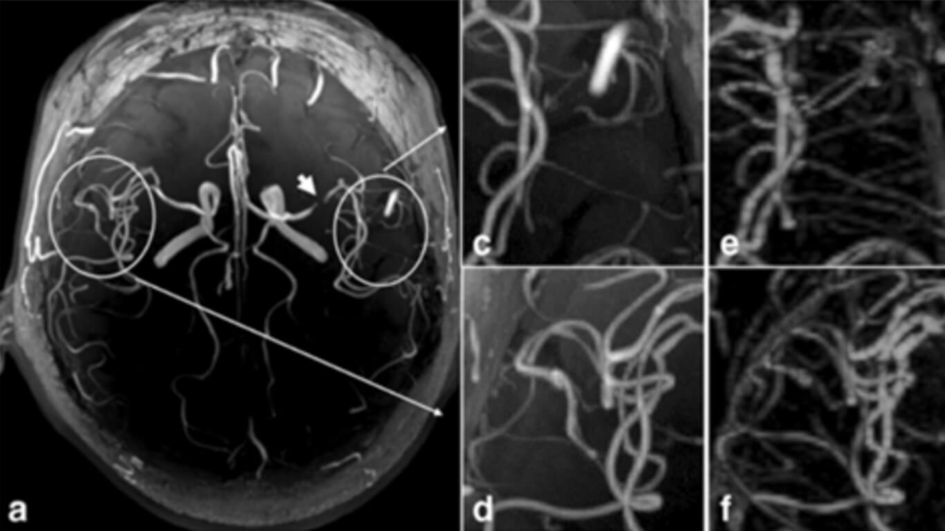 STAGE Angiography edit