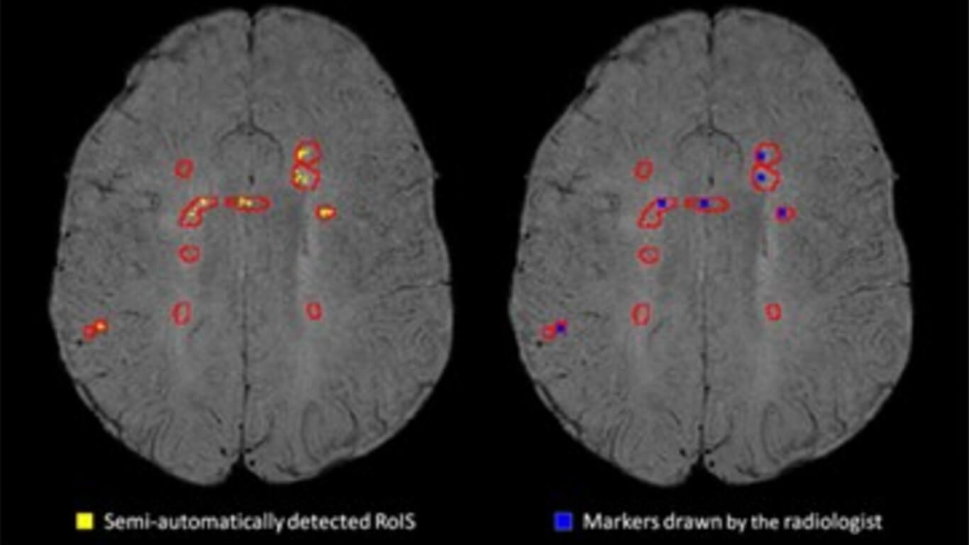 Semi Automatic Detection Of Increased Susceptibility In Multiple Sclerosis White Matter Lesions