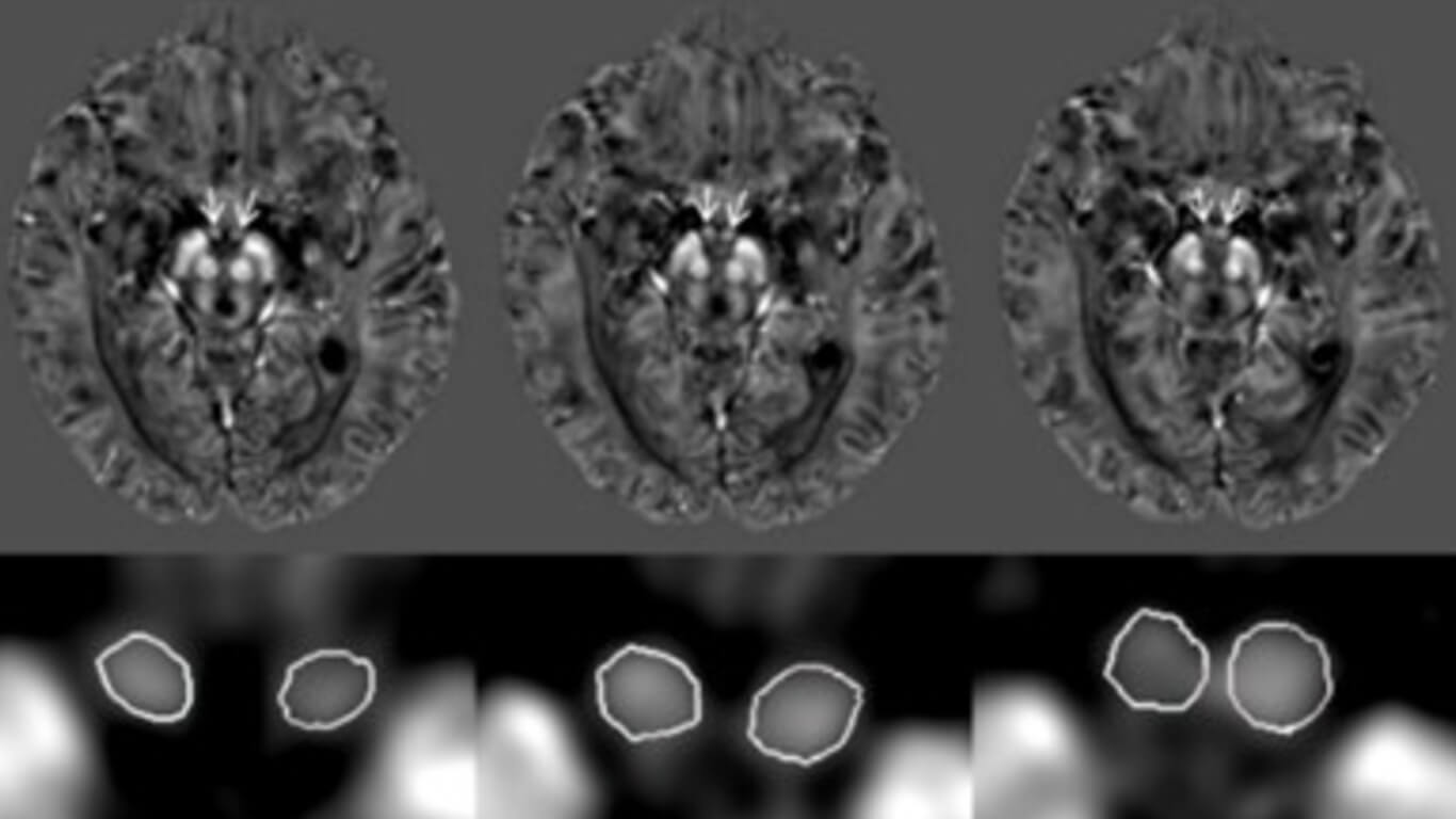 Mammillary Volume Measures edit