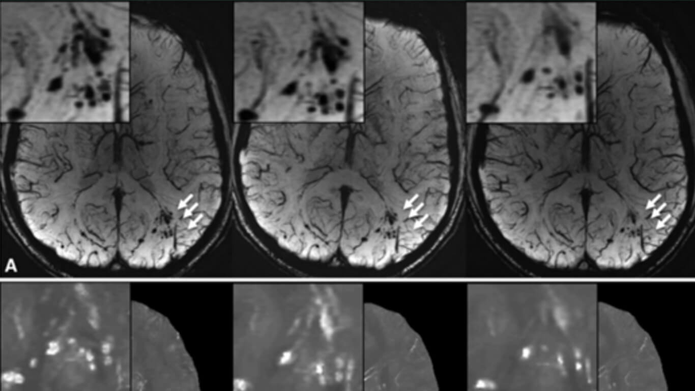 Military Microhemorrhages edit