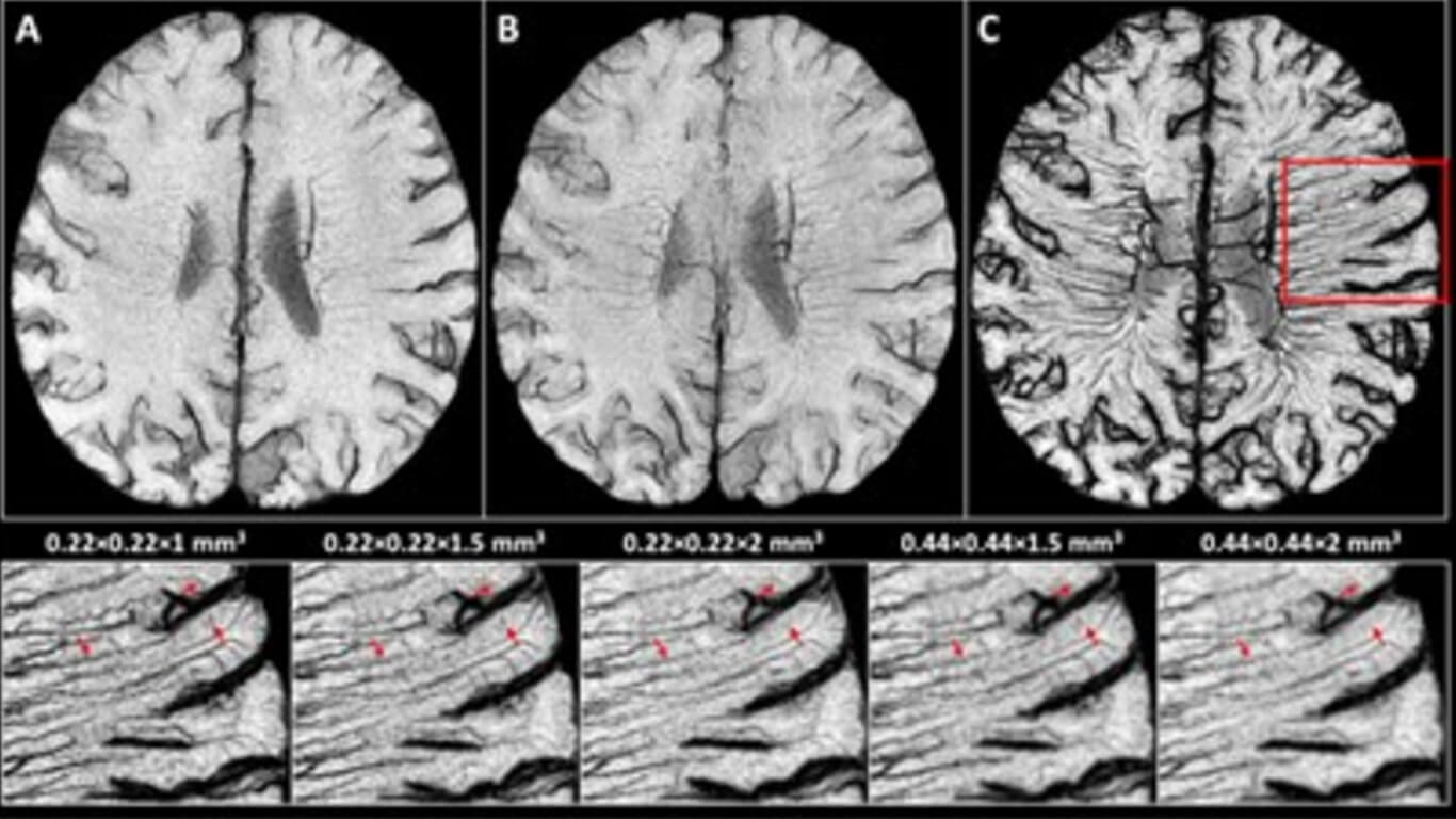 Vascular Abnormalities MS edit