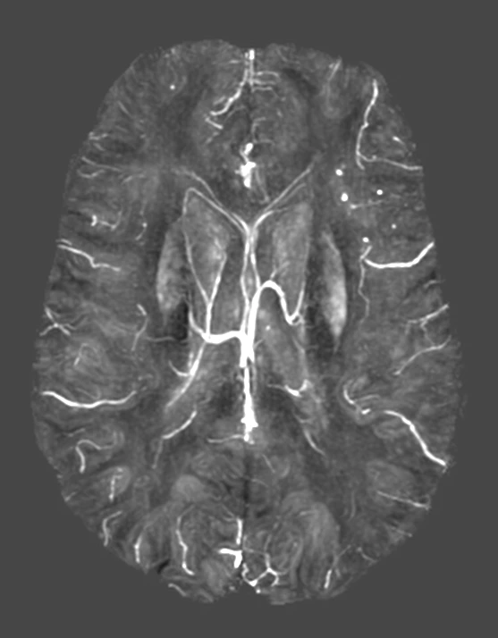 Use Case - Dementia1