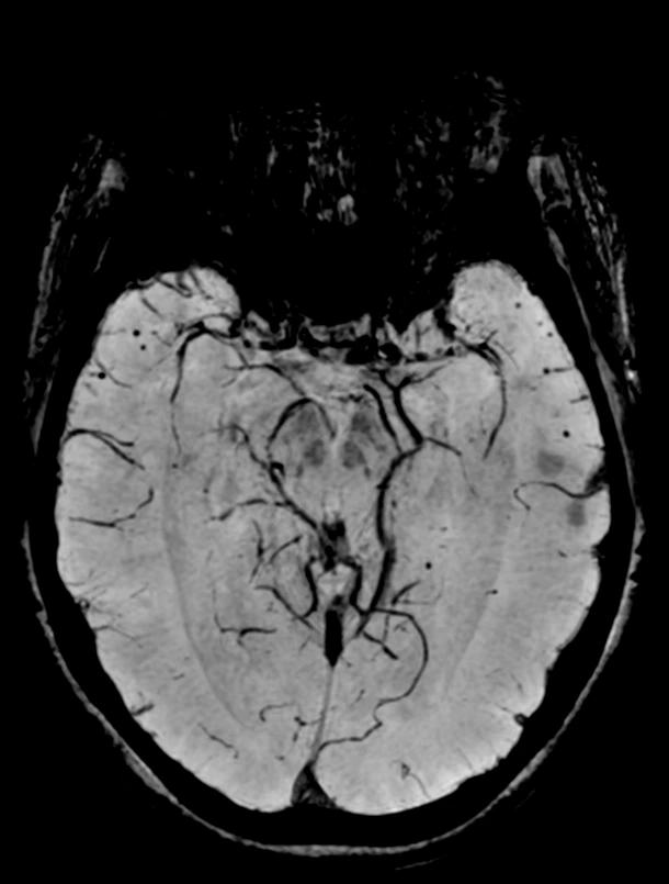 Use Case - Dementia2