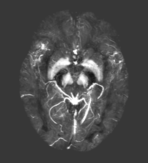 Use Case - Parkinsons Disease