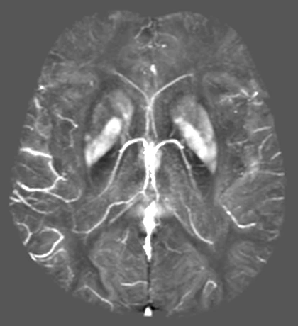 Use Case - Stroke