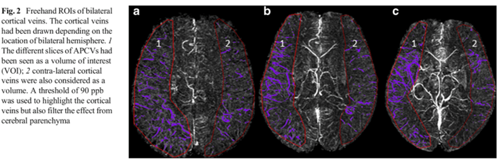 Bilateral Cortical Veins