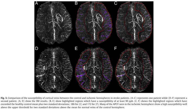 Cortical Vein Susceptibility