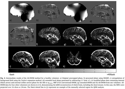 Dural Sinus Scan