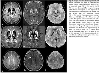 Intracranial Iron Aceruloplasminemia