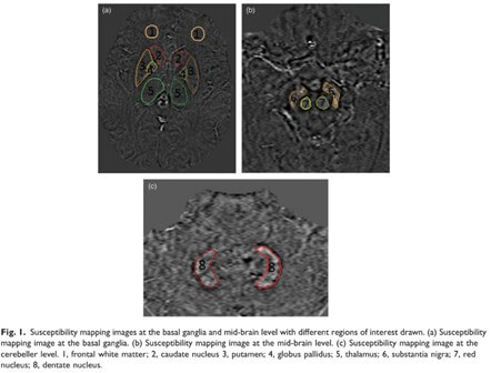 Iron Deposit Cirrhosis