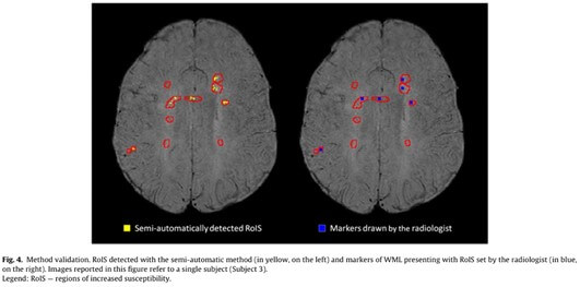 MS White Matter