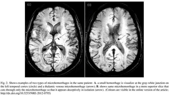 Microhemorrhages Minor TBI