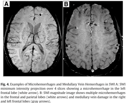 Microhemorrhages SWI