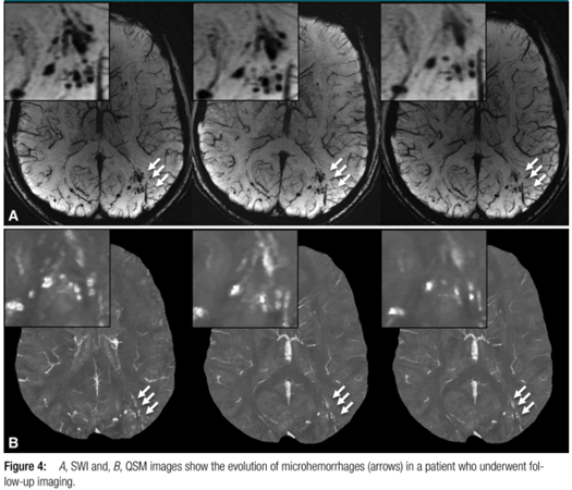 Military Microhemorrhages 1