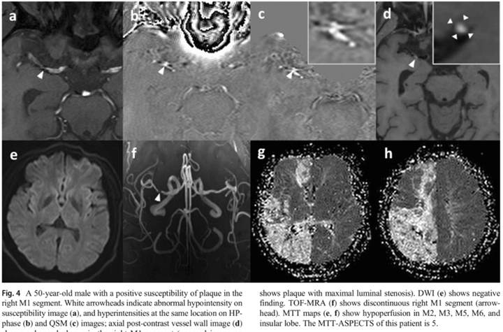 Plaque Susceptibility