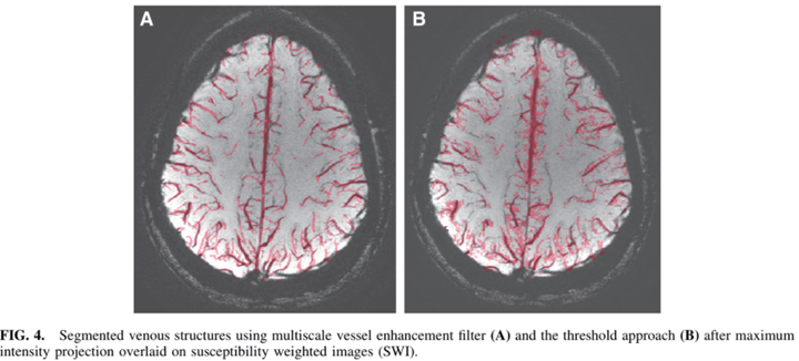 Segmented Venous Structures