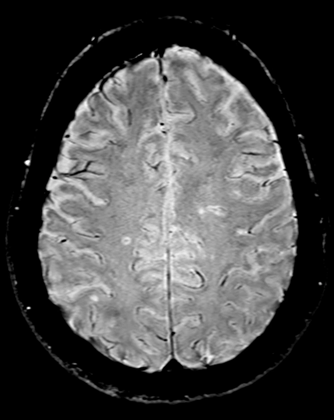 Use Case - Multiple Sclerosis1