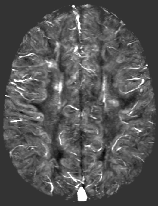 Use Case - Multiple Sclerosis2