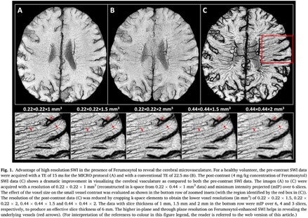 Vascular Abnormalities MS