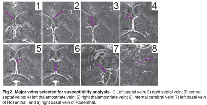 Vein Susceptiblity Analysis